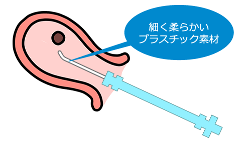 カニューレを用い、手動でポンプを操作して吸い出すMVA(手動真空吸引法)の手術イメージ図