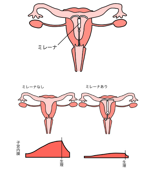 子宮内にミレーナを装着した際のイメージ図